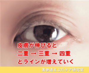 片目の三重まぶたが治った！ 二重に戻す方法が好評です。