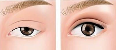 眼瞼下垂を自力で治したい 自分で治すのは困難