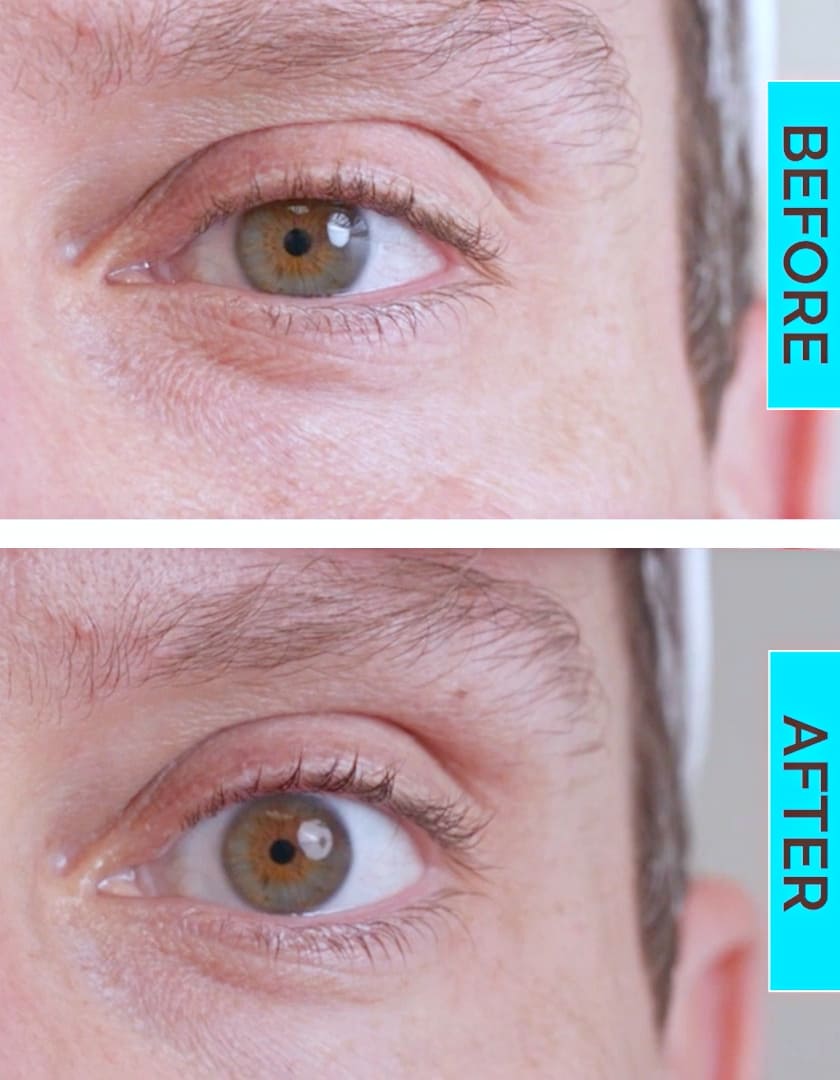 目薬 眼瞼下垂治療薬 左目の効果