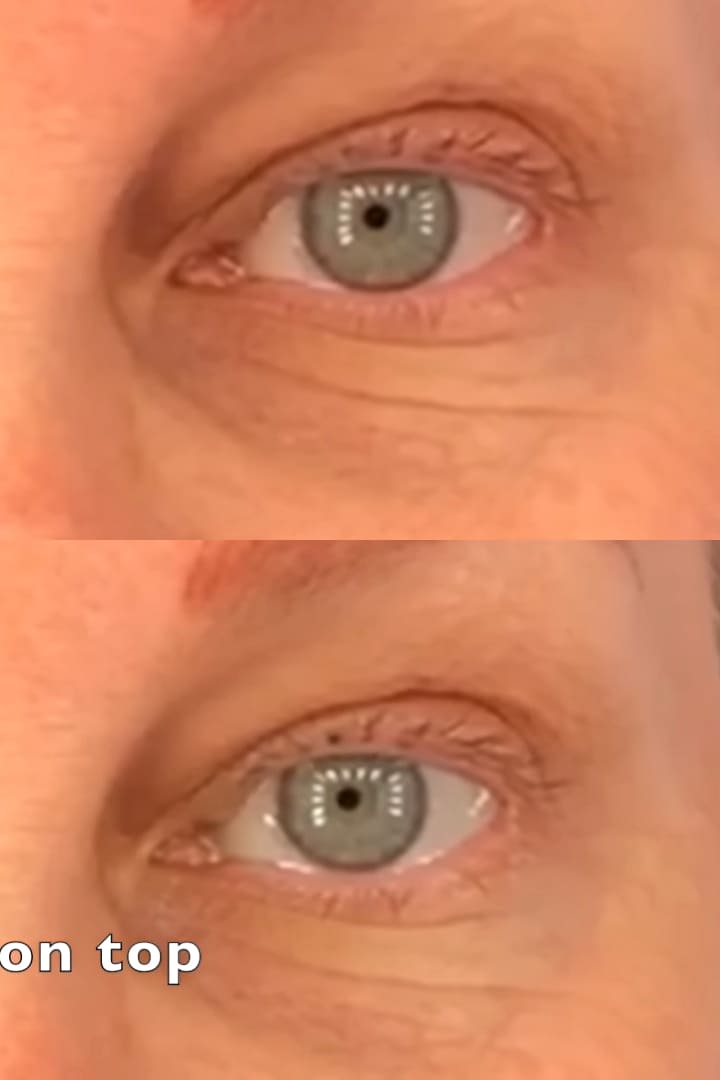 目薬 眼瞼下垂治療薬 左目の効果