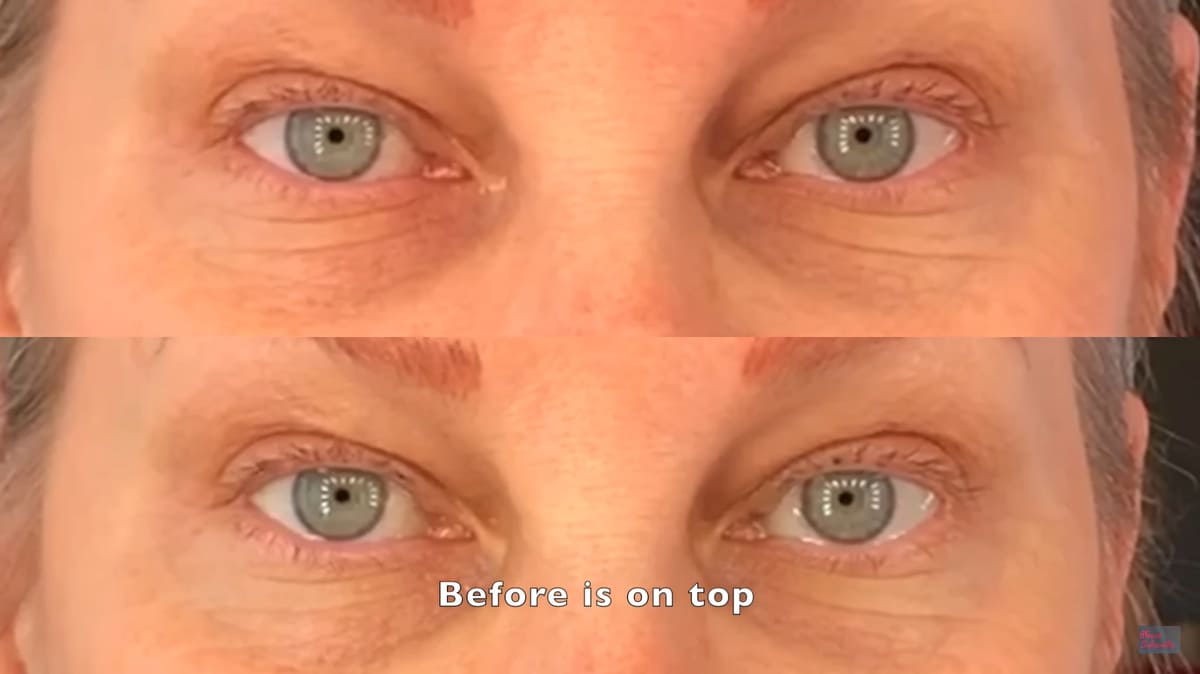 目薬 眼瞼下垂治療薬 効果
